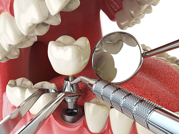 Best Urgent Tooth Repair  in Springfield, IL